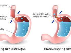 Sự thật về trào ngược dạ dày thực quản và cách chữa bệnh hiệu quả